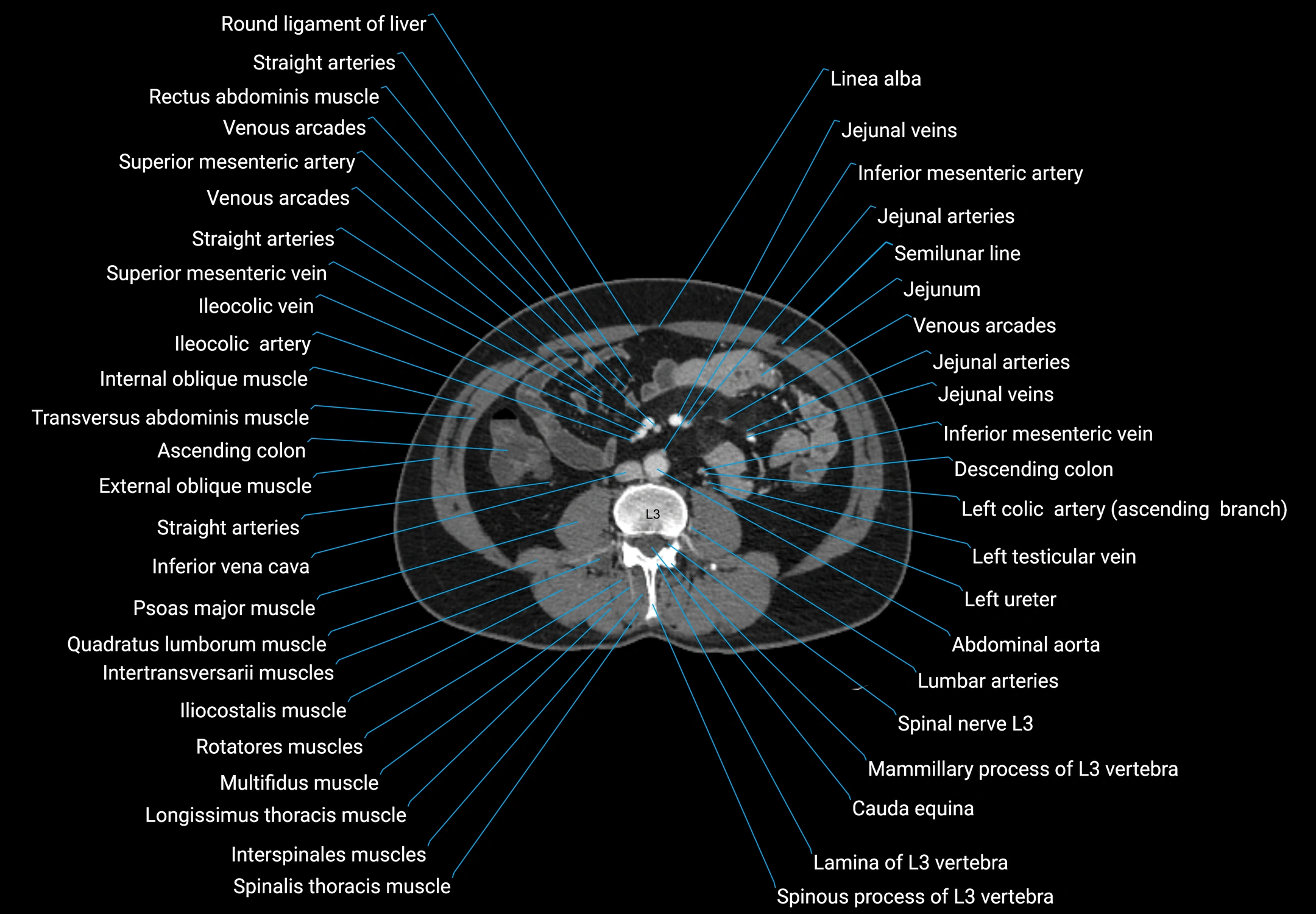 CT male pelvis axial cross sectional anatomy labelled radiology image -00093.webp